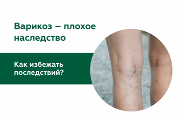 Варикоз – плохое наследство