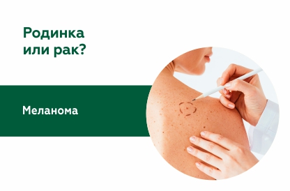 «Черная королева» онкологии. Опасно ли удалять родинки?